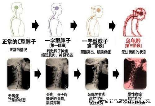 驻马店天祥骨病医院老张家膏贴:椎动脉型颈椎病的治疗方法