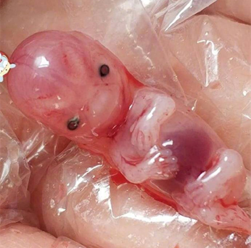 三个月胎儿药流下来图图片