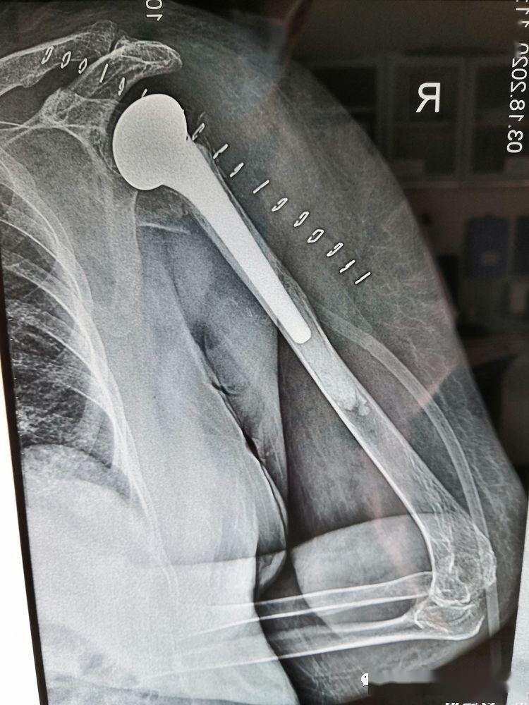 【新技术】洪洞县首例人工肩关节置换术在洪洞县中医医院成功开展