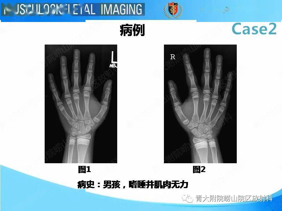 儿童干骺端解剖图图片