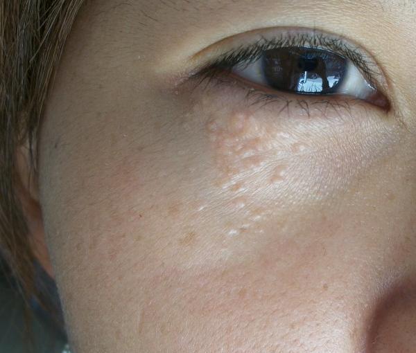 脸上的脂肪粒让人苦恼,去除的窍门我这有几招_皮肤