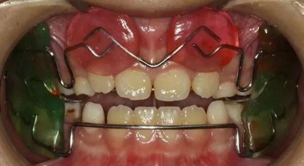 fr-3功能矫治器隐形矫治器以上矫正体系在口腔正畸科均有成熟的运用