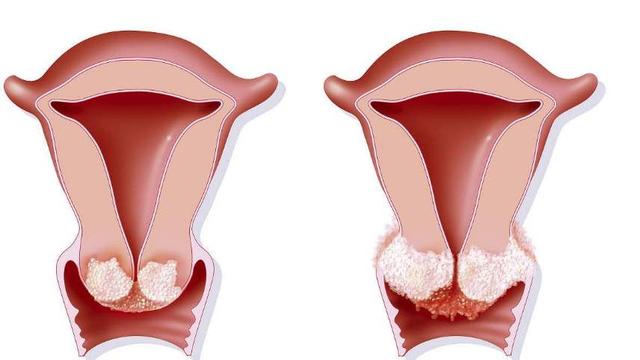不容忽视的宫颈糜烂病变起来要你命