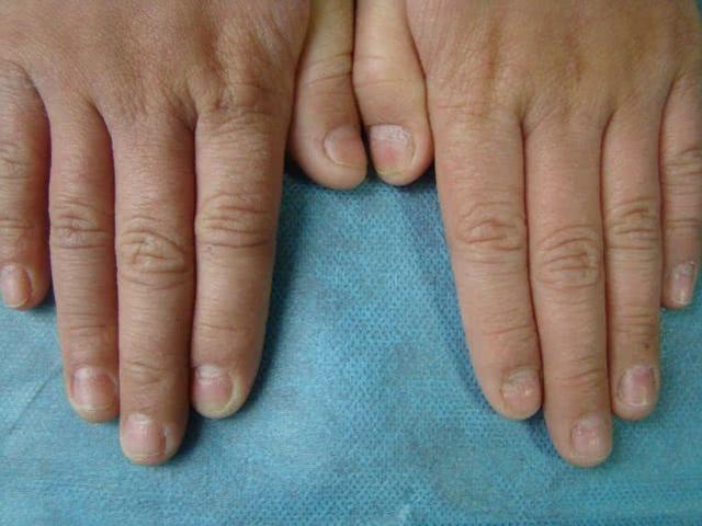原创经常消化不良脸色发黄指甲出现一种现象都是在暗示要养肝