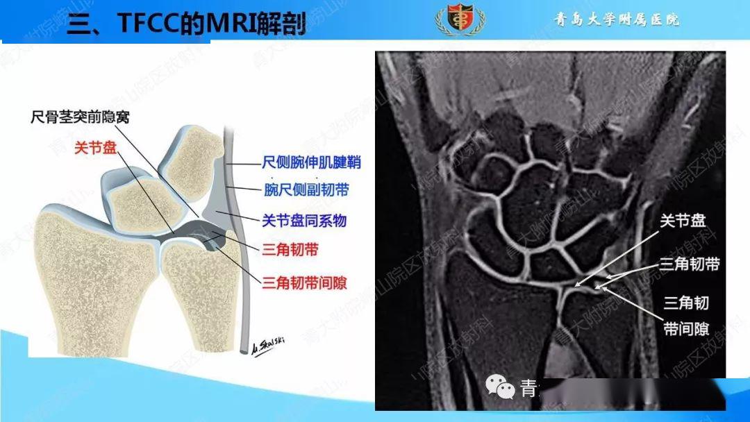 tfcc损伤的mri诊断