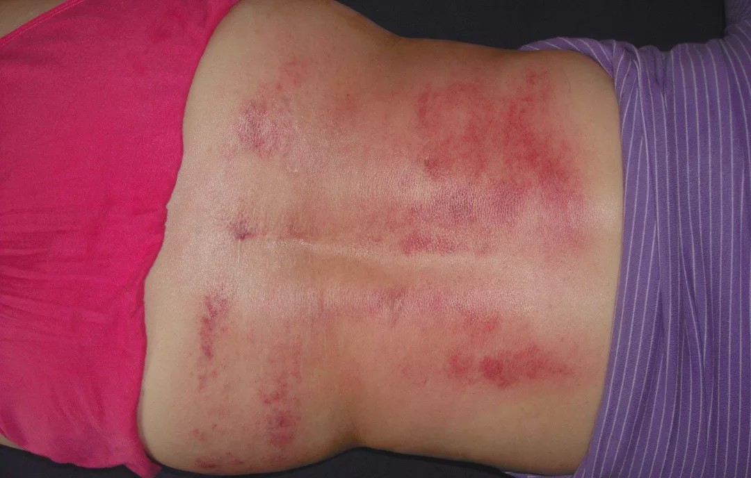 现代人没有体力活哪来的腰肌劳损是不是被误诊了