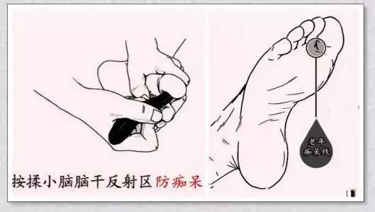 其实,她脚上的那条棱线就是痴呆线,严重的会形成一块硬皮,像茧子似的.