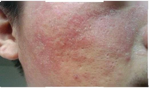 警惕这种宅出来的皮肤病脂溢性皮炎的预防及治疗