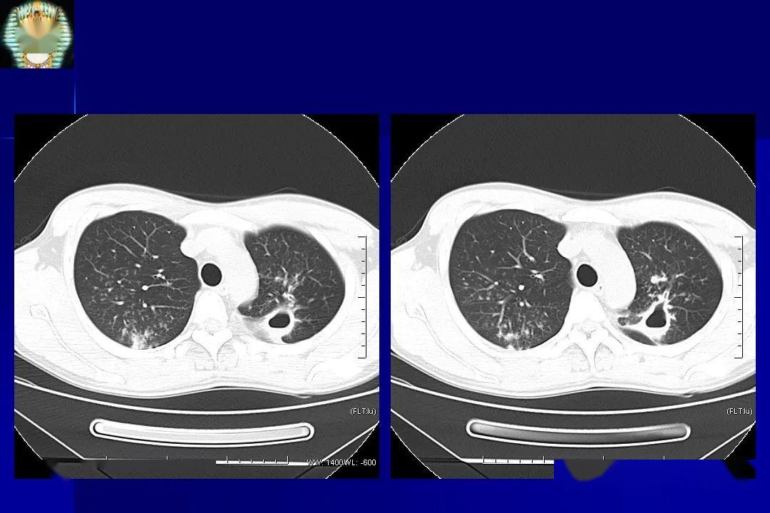 肺结核的影像学诊断_文库