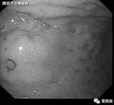 胃印戒细胞癌胃镜图片图片