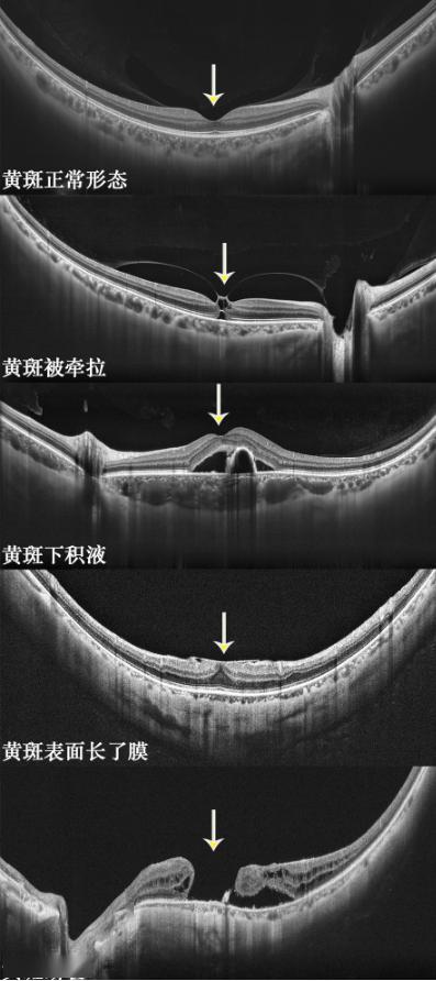 黄斑板层裂孔图片