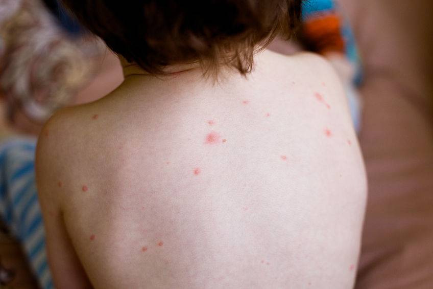 原创孩子身上有4个异常当心惹了荨麻疹若反复发作最好求医