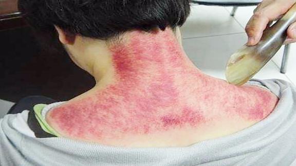 身体不舒服又查不出病?说明身体处于亚健康,试试硬币刮痧法!