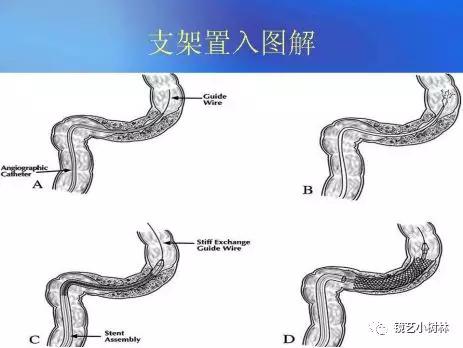 为你打开一扇门记特殊时期2例消化道恶性狭窄支架植入术