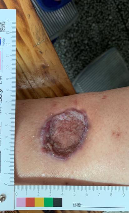 黔南州中医医院民族医学科慢性伤口治疗