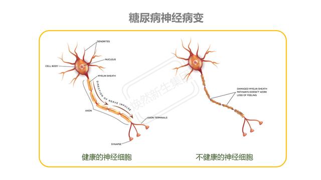 糖尿病神经病变图片