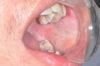 图6 osf 治疗后颊黏膜图7 osf 治疗后唇黏膜图8 osf 治疗后腭黏膜口腔