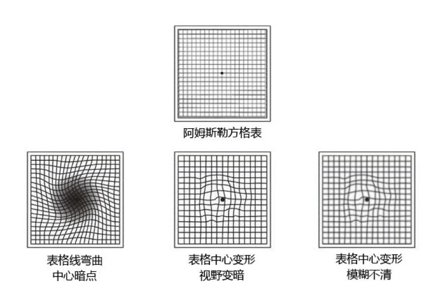 黄斑网格图图片