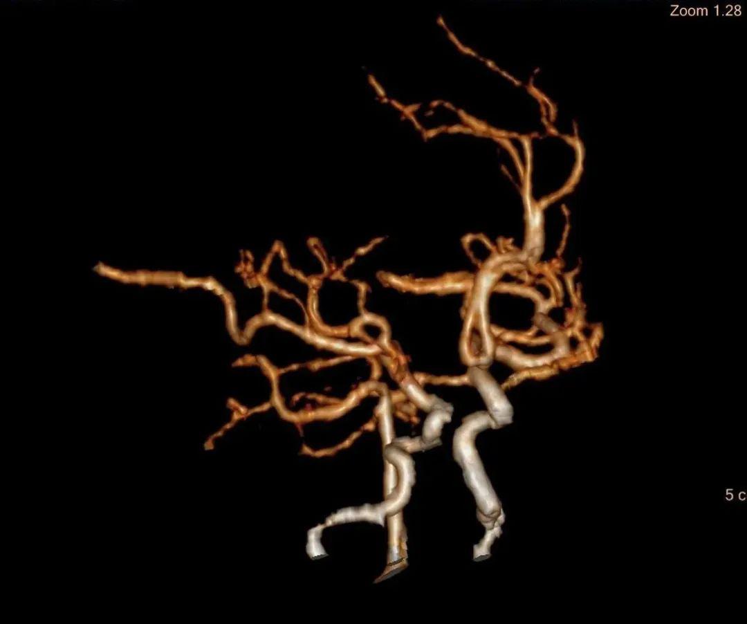 渭南市第二医院医学影像科颅脑cta脑灌注ctp一站式成像新突破