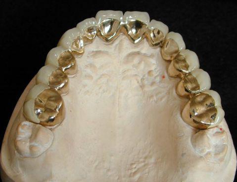 各类假牙汇总最贵的假牙价值近百万