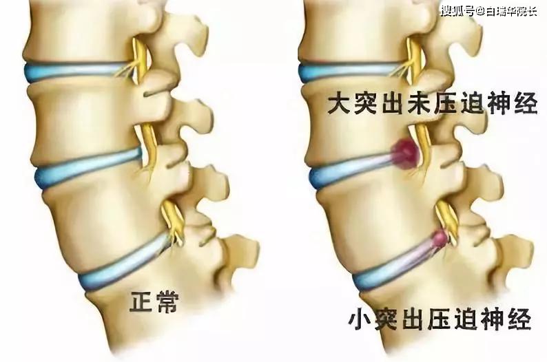 腰椎突出来图片