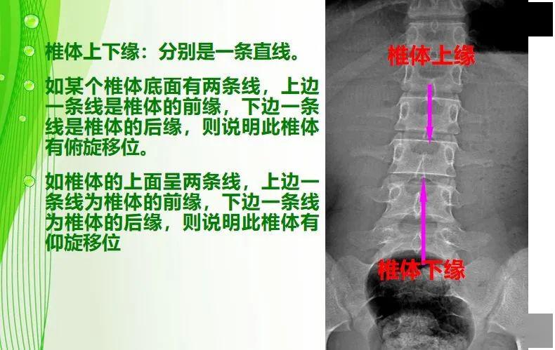 3,腰大肌异常影像学改变:(1)正常腰大肌八字形消失(2)腰大肌八字形