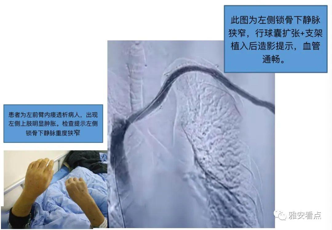 自体动静脉内瘘患者,因中心静脉血管病变导致回心血流不通畅,引起上肢