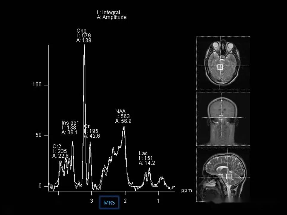 醫學影像英語每日讀丨146.brainstem glioma( 腦幹膠質瘤)