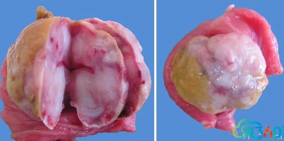 肠道ebv相关性平滑肌肿瘤