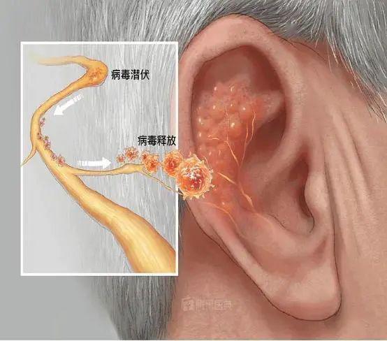 耳周帶狀皰疹3.周圍性面癱輔助檢查1.面神經電圖,面肌電圖2.