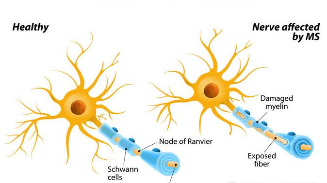 头痛属于脑白质脱髓鞘吗