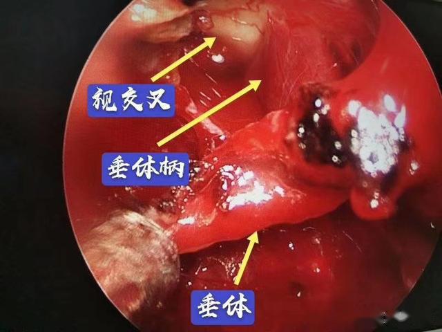 "颅咽管瘤"的方式,磨除鞍结节骨质,充分显露肿瘤上极,采取锐性分离,将