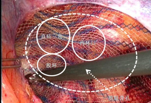 腹腔补片手术后图片图片