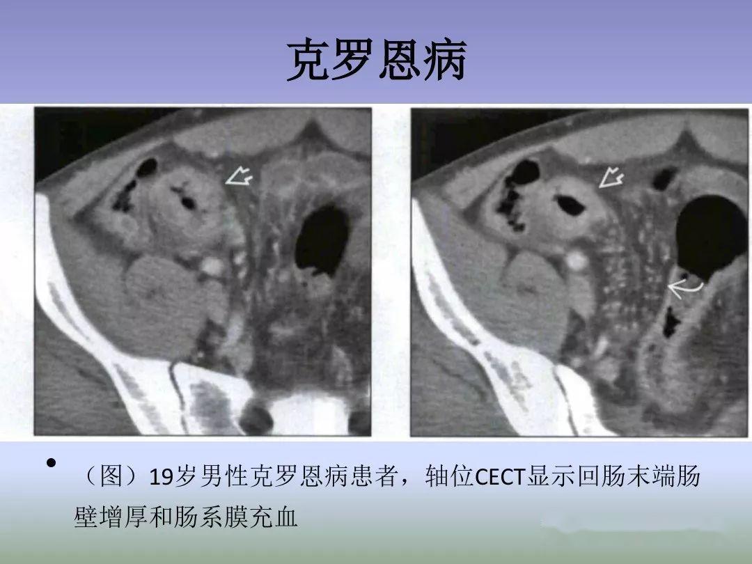 回盲部占位或炎症的影像鉴别诊断