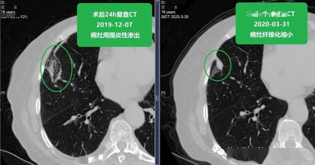 靳勇2019-12-5行ct示右肺中葉一磨玻璃結節,形態不規則,周圍見毛刺