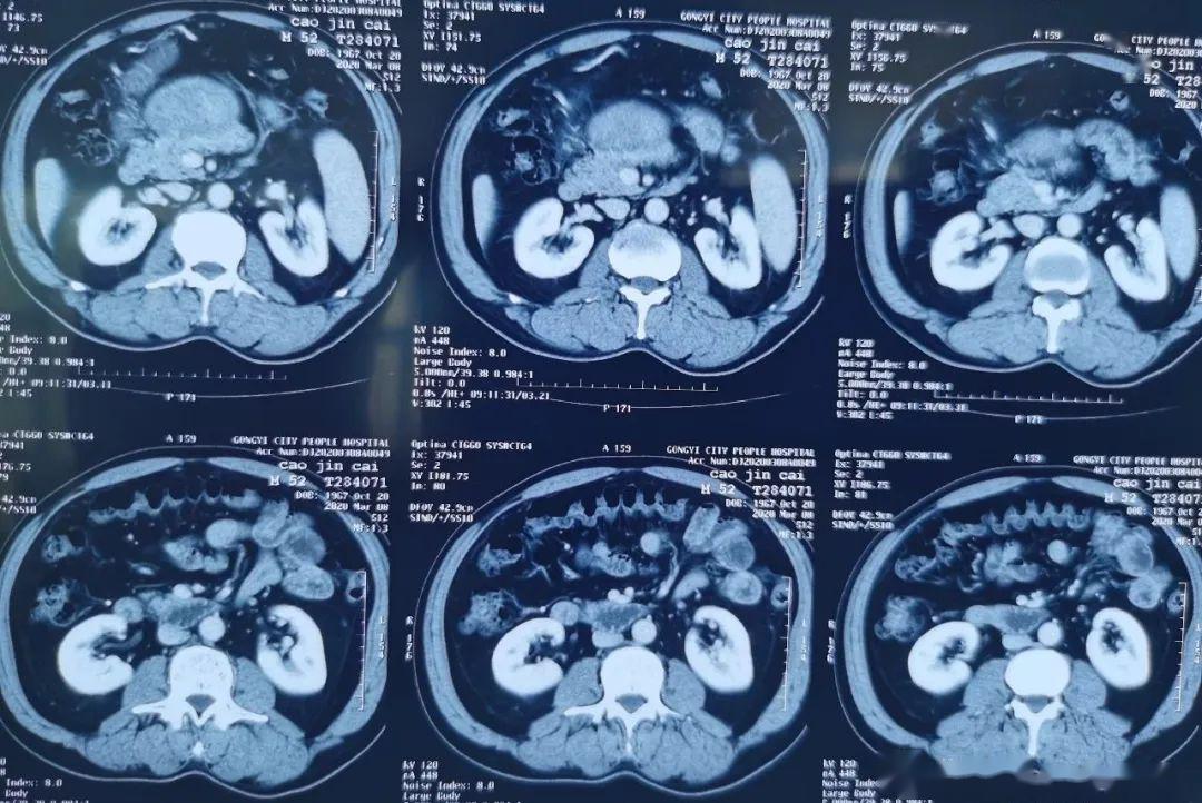 大話腹膜後腫瘤第一季第十三集再論三層四間隙理論