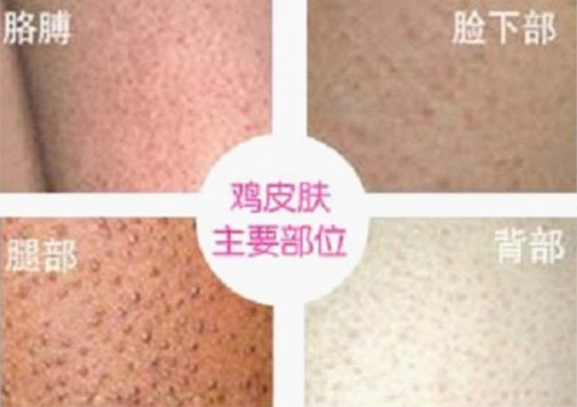 果酸换肤鸡皮肤区别(鸡皮肤果酸换肤多少钱一次)