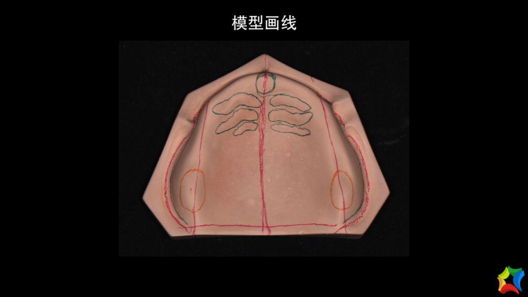 2,预约技术支持上门制作暂基托,排牙试戴,边缘整塑,取终印模(在门诊)3