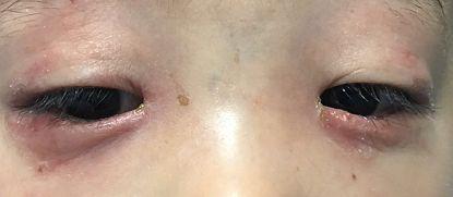 反复眨眼揉眼的过敏结膜炎孩子该怎么治疗