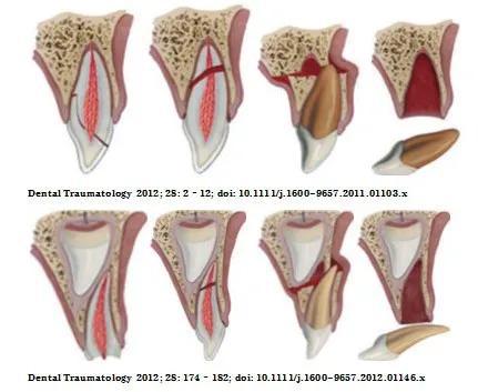 1.牙外伤类型复杂,其中恒牙中牙折最常见,而牙脱位常见于