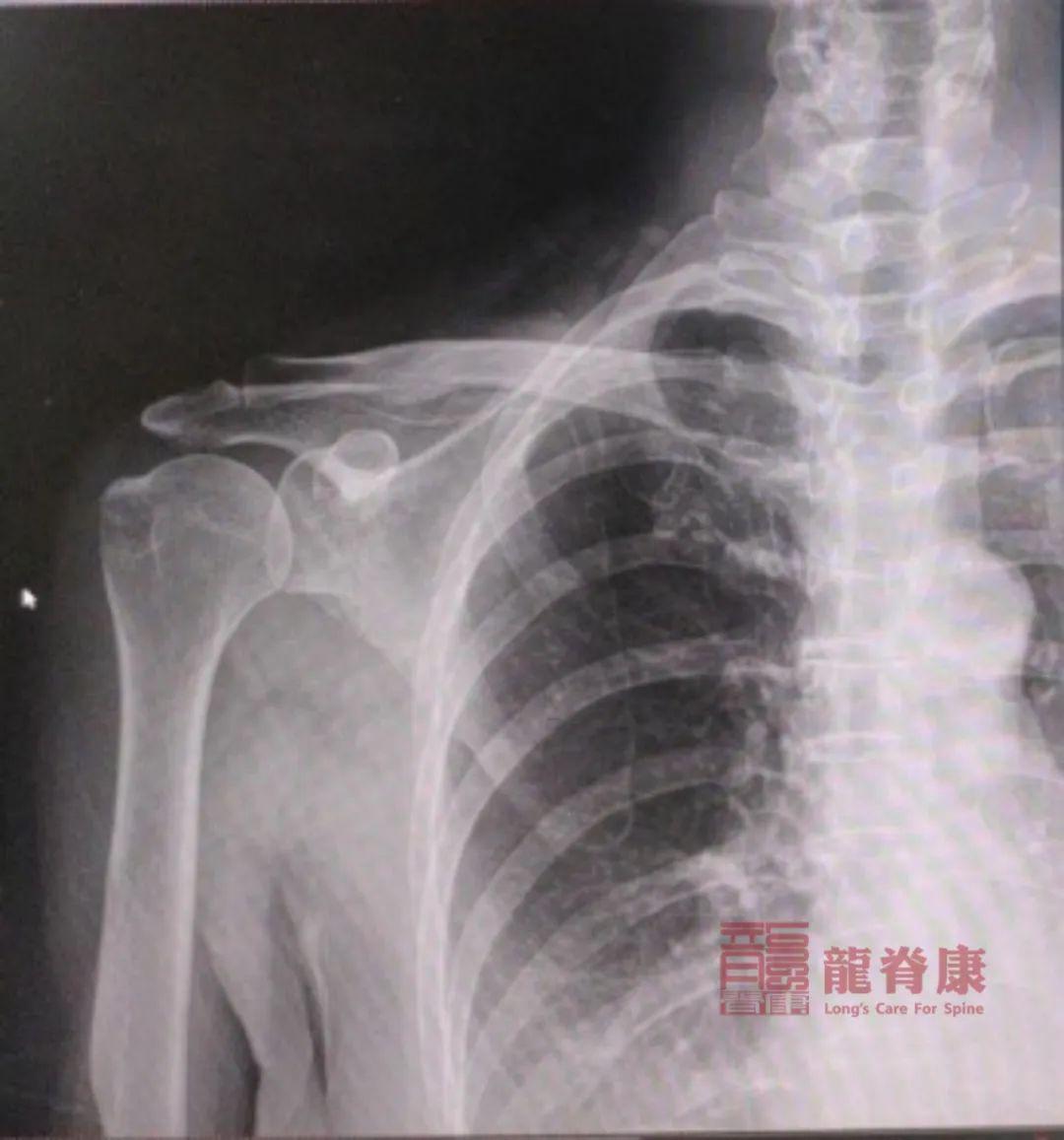 病例:肩周炎如何鉴别诊断?