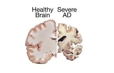 阿尔兹海默症研究进展一览_大脑