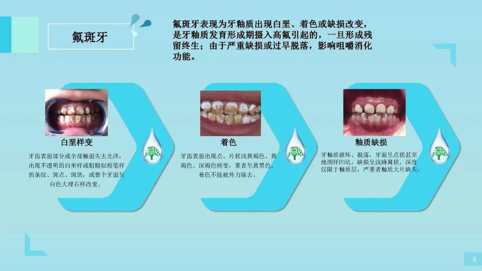 健康科普 饮水型地方性氟中毒你需要知道这些!