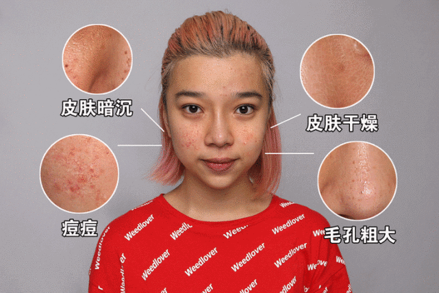 其实肤色的暗沉只是一个形容词,一个各种面部皮肤问题集合现象的总称.