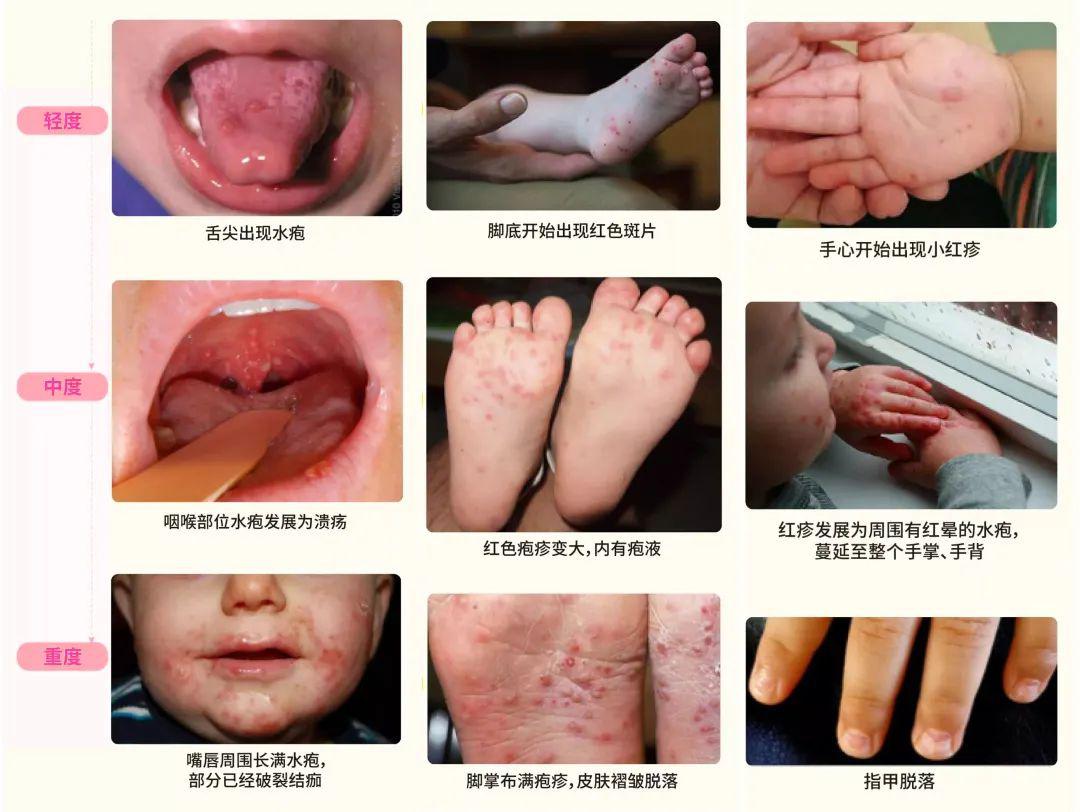 天渐暖某些病毒更爱作妖46月份家长要格外注意这个病毒