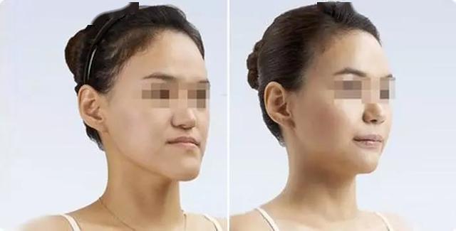 造成发音异常,后牙锁颌影响咀嚼功能,严重的下颌前突造成吞咽异常