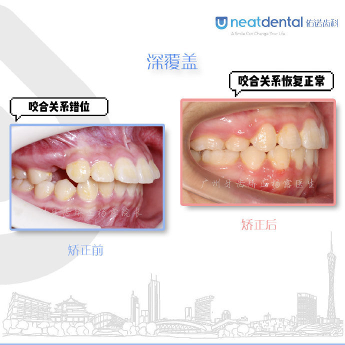 广州牙齿矫正杨露医生:正畸案例整理合集(一)