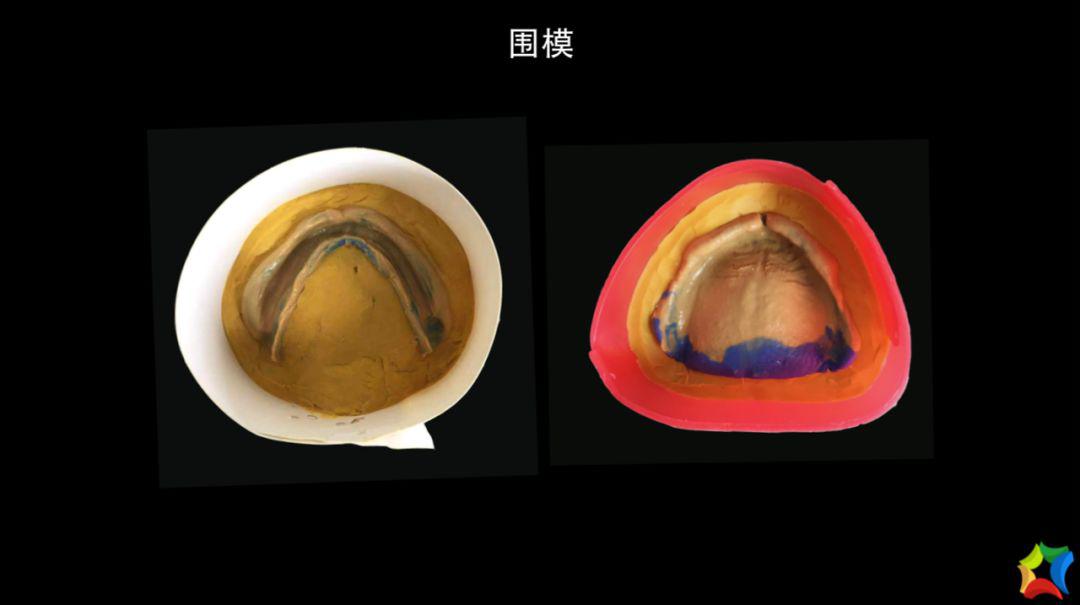 金賽義齒精製義齒修復病例