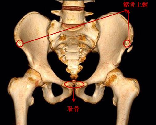 对于骨盆,从骨骼的角度来说,正常的体态需要髂前上棘和耻骨在同一冠状