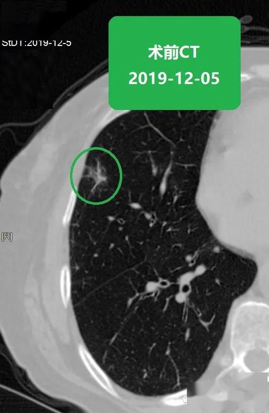 苏大附二院靳勇医生团队病例分享第47期肺磨玻璃结节的消融
